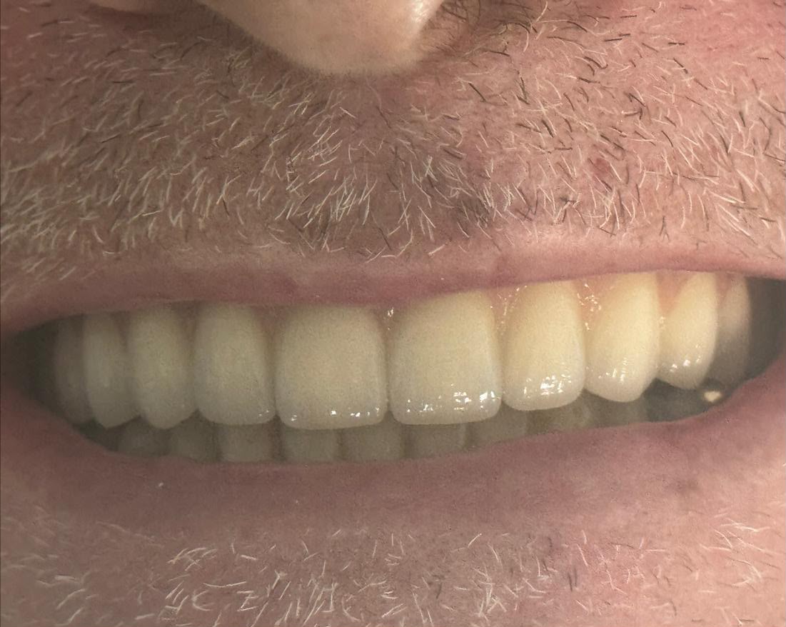 Depois — Instalação dos implantes para confecção de uma Prótese Protocolo superior (dentadura fixa)